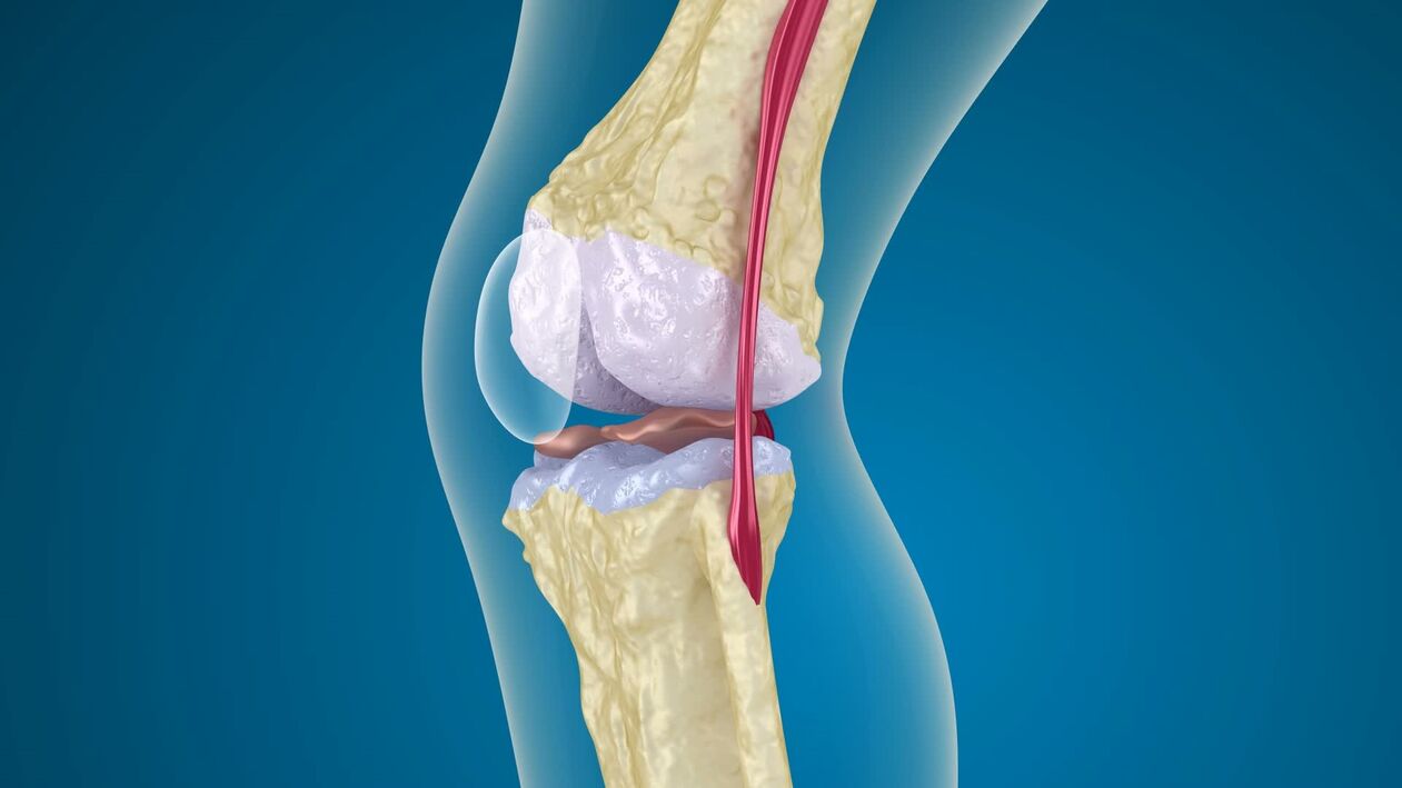 destrukce kolenního kloubu s artrózou