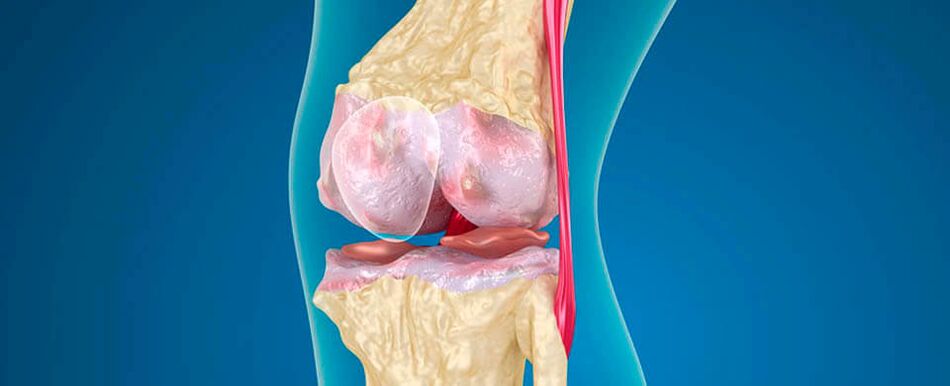 artróza kolena jako příčina bolesti