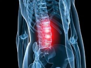 Osteochondrosis bederní páteře