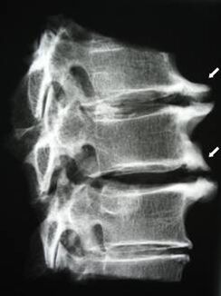 Osteofyty krční páteře způsobují bolesti krku