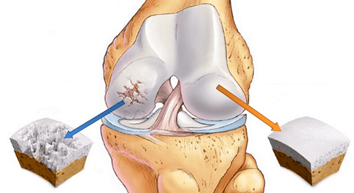zdravé chrupavky a chrupavky postižené artrózou